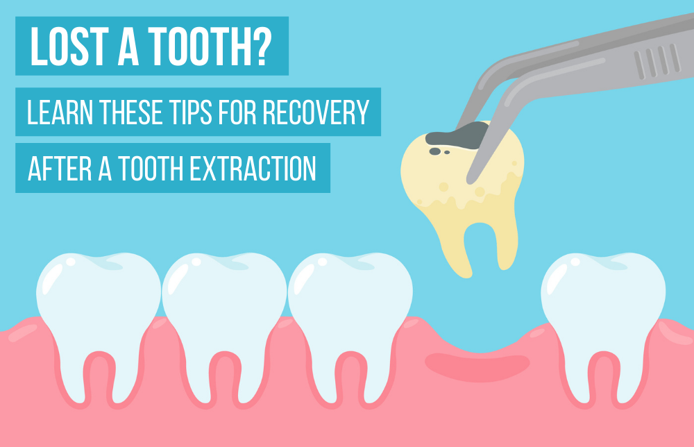 Lost A Tooth? Learn These Tips For Recovery After A Tooth Extraction. Image